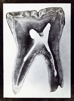  Joseph Albert: „Durchschnitt eines Backenzahnes vom Menschen“, 1861